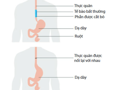Phẩu thuật ung thư thực quản Phẩu thuật ung thư thực quản